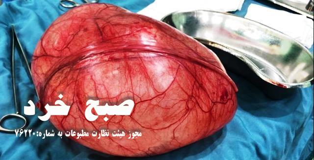 خارج کردن کیست ۳۰ سانتی متری از شکم خانمی ۶۳ ساله در بیمارستان دهدشت /+ تصاویر
